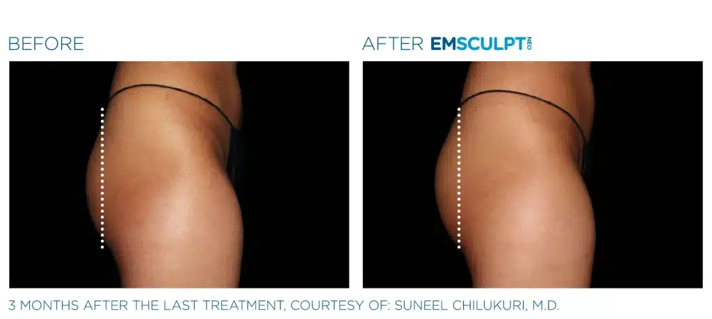 Emsculpt NEO before and after treatment results, Seashore MD in Little Silver, NJ.