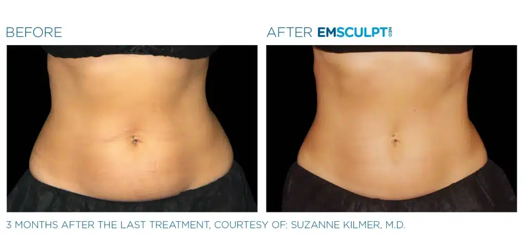 Emsculpt NEO before and after treatment results, Seashore MD in Little Silver, NJ.