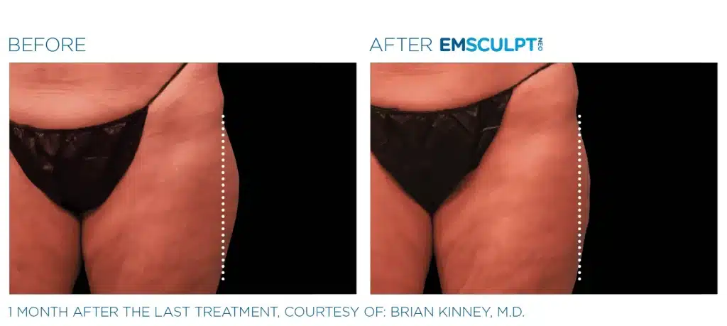 Emsculpt NEO before and after treatment results, Seashore MD in Little Silver, NJ.