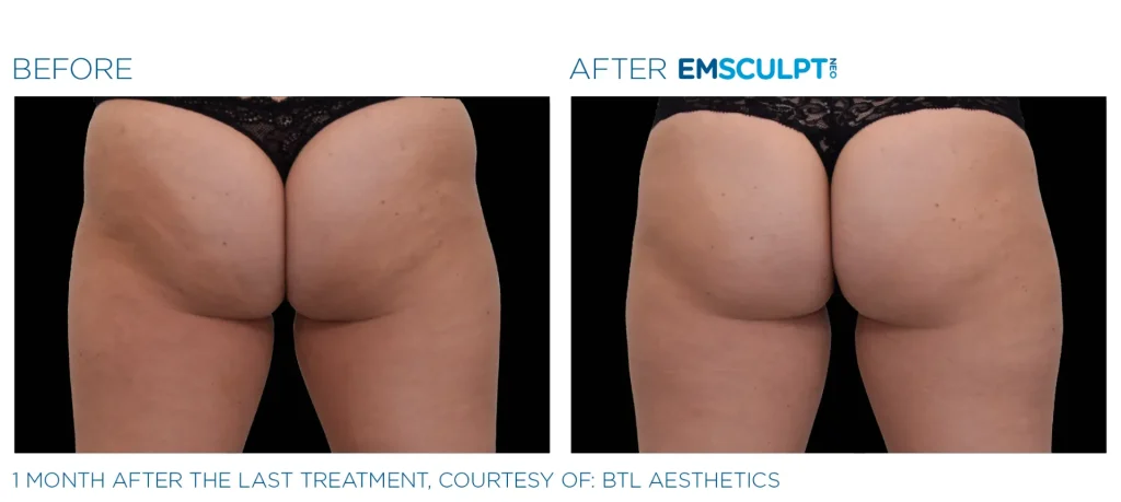 Emsculpt NEO before and after treatment results, Seashore MD in Little Silver, NJ.