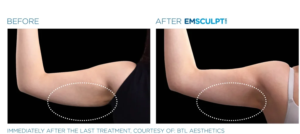 Emsculpt NEO before and after treatment results, Seashore MD in Little Silver, NJ.